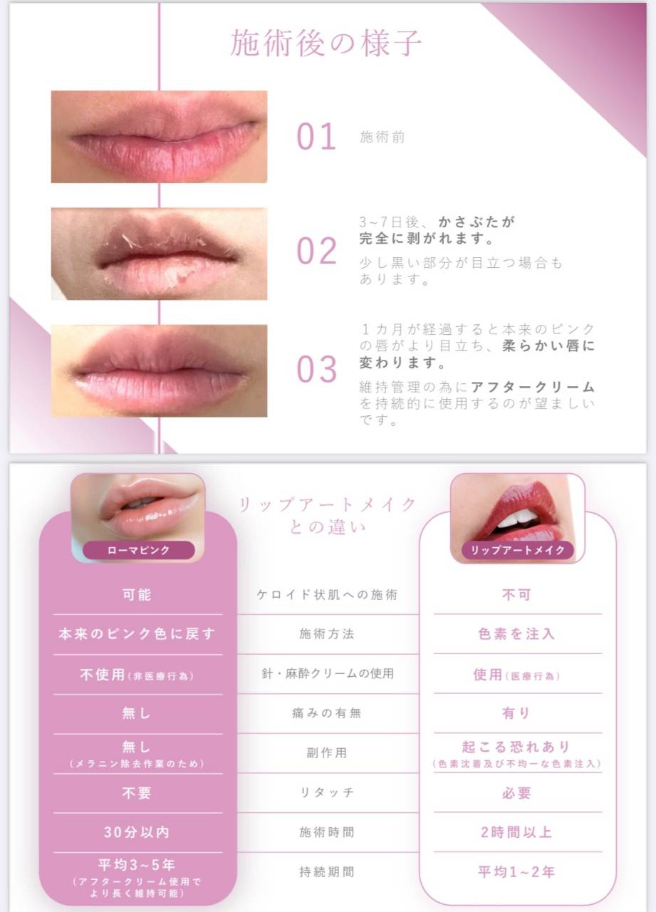 ローマピンク | ブログ | 名古屋のメンズ脱毛ならK_nine（ケーナイン）